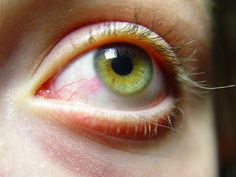 the eye of a young person with red spots on their iris and yellow eyeshadow