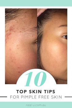 Hey Beauties, using the real-u 3 step program has proven to be effective for clearing acne and pimples but to get the best results, follow these must-know acne skin tips. Hey Beauty, here are our must-know acne skin tips to help you get the best results out of your skincare routine. 1. ALWAYS CLEANSE TWICE WHEN YOU WEA Ways To Clear Acne, Clearing Acne, Pimple Free Skin, Before And After Pics, Pimples Remedies, Cleanser For Oily Skin, Prevent Pimples, How To Get Rid Of Pimples