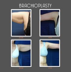 four images show the different angles of brachioplasty