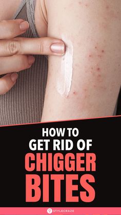 Chigger Bite Remedy, Herbal Knowledge, Home Cleaning Remedies, Bug Bites Remedies, Apple Cider Vinegar For Skin, Diy Cleaning Products Recipes, Diy Pest Control, Lawn Care Tips, Homemade Oil