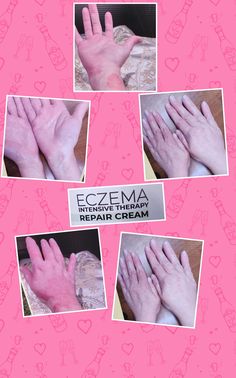 Our Eczema Healing Cream is a natural solution for itchy, irritated skin, + inflammation. Tallow base lotion Crafted by hand with a blend of all-natural ingredients, this rich, hydrating cream offers relief without resorting to harsh chemicals or prescription medications. Combination of 100^ organic beef tallow, vitamin E, organic grapeseed oil, and  selection of healing essential oils.  Regular application of our Eczema Healing cream alleviate the discomfort, itching, and cracking associated with eczema + other troublesome skin conditions. Florida Farm, Healing Essential Oils, Beef Tallow, Hydrating Cream, Medical Prescription, Grapeseed Oil, Skin Conditions, Vitamins And Minerals, Irritated Skin