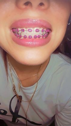 Jewelry Teeth, Braces Colors Ideas, Braces Bands, Teeth Gems