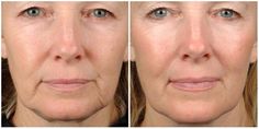 Skin Tightening Procedures, Cheek Lift, Cosmetic Dermatology, Crepey Skin, Wrinkle Reduction, Skin Tissue, Improve Skin Tone, Skin Clinic, Face Lift