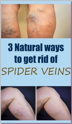 Home Remedies For Spiders, Get Rid Of Spiders, Birth Control Pills, Hormonal Changes, Blood Vessels, Healthy Tips, Natural Health, Cleaning Clothes, Home Remedies