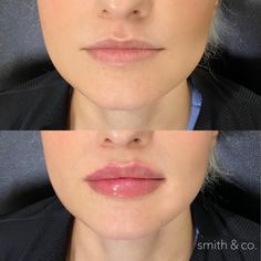 Kysse Lips Filler, Lip Inspo Filler, Lip Fillers Before And After, Lip Injections Before And After, Before And After Lip Fillers, Lip Filler Shape Ideas, Lip Filler Before And After, Lip Filler Inspiration, Lip Blushing