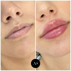 Lips Inspiration, Botox Filler, Natural Mouthwash, Beauty Lips, Facial Aesthetics