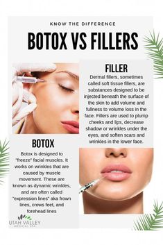 Botox Injection Sites, Botox And Fillers, Cosmetic Fillers, Face Fillers, Facial Fillers, Facial Aesthetics, Botox Fillers, Aesthetic Medicine