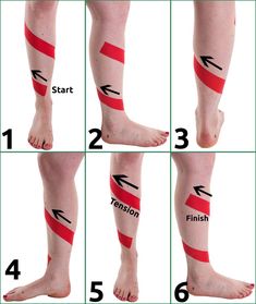 Shin Splints Taping, Athletic Training Sports Medicine, K Tape, Kt Tape, Kinesio Taping, Volleyball Tips, Kinesiology Taping