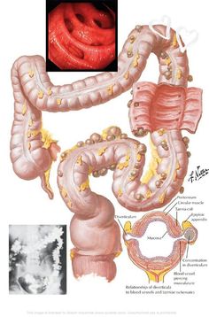 Low Residue Diet, Low Fiber Diet, Colon Health, Fiber Diet, High Fiber Diet, Medical Coding, Large Intestine, Colon Cleanse, Nursing Notes