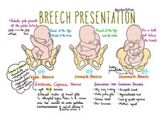 Fetal Presentation, Nursing Cheat Sheet, Midwifery Student, Nursing Cheat, Nursing School Notes, Nursing Notes, Love My Job, School Notes, Neuroscience