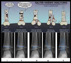 the stages of an ankle injury and how they are different ways to treat them out