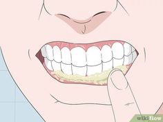 3 Simple Ways to Treat a Gum Infection - wikiHow Swollen Gums Remedy, Gum Sores, Remedies For Dry Mouth, Dental Routine, Dental Infection, Tooth Infection, Gum Inflammation