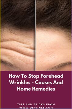 How To Stop Forehead Wrinkles - Causes And Home Remedies #foreheadwrinkles #foreheadwrinklescauses #foreheadwrinklesprevention #foreheadwrinklesremovalremedies #beauty #beautytips #skincare #skincaretips #remedies #homeremedies #DIY #acne #acnescars #darkspots #skinspots Get Rid Of Deep Forehead Wrinkles, How To Stop Forehead Wrinkles, How To Remove Wrinkles On Forehead, Dry Forehead, Natural Wrinkle Remedies, Home Remedies For Wrinkles, Anti Aging Remedies, Lotion For Oily Skin, Wrinkle Remedies