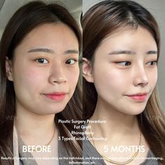 For more information: ❤️Whatsapp: +82-10-2103-7174 💛Kakao: viewinquiry 💚LINE: viewinquiry ✉️E-mail: eng_viewps@viewclinic.com 💎Website: www.viewplasticsurgery.com Change Appearance, Official Account, Anime Boyfriend, Korean Language, Korean Makeup