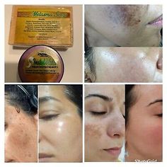 Hyperpigmentation Mask, K Tape, Pimples Under The Skin, Blackhead Remover Tool, Dark Spots On Face, Skin Lightening Cream, Brown Spots Removal, Skin Tags, Lightening Creams