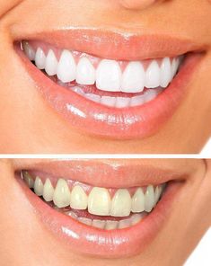 WebMD looks at the many available teeth whitening systems, along with products like toothpastes and gels, and compares home kits to professional office treatments. Teeth Whitening Professional, Coconut Oil Teeth Whitening, Natural Teeth Whitening Remedies, Jessica James, Teeth Whitening Toothpaste, Teeth Whitening Gel, Charcoal Teeth Whitening