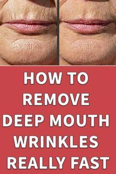 Unwanted Hair Permanently, Get Rid Of Wrinkles, Wrinkle Free Skin, Best Skin Care Routine, Younger Skin, Face Wrinkles, Deep Skin