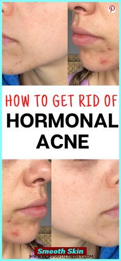 💯 Your Guide to Perfect Skin: Top Facial Products 💞 Get Rid Of Hormonal Acne, Summer Hair Care, Balancing Hormones, Pimples Under The Skin, Gut Healing Recipes, Pink Nail Colors, Baby Pink Nails, Mole Removal