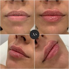 Top Heavy Lip Filler, Lip Flip Vs Filler, Natural Lip Fillers 1ml, 1ml Lip Filler Before And After, 0.5 Lip Filler Before And After, Light Lip Filler, Natural Lip Fillers 0.5ml, Pouty Lip Filler