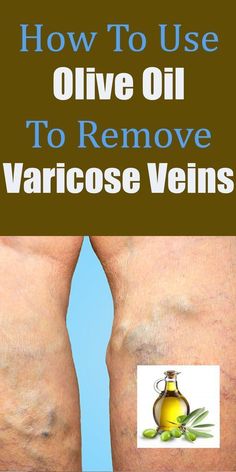 Hand Therapy Exercises, Varicose Vein Removal, Reflexology Chart, Natural Health Tips, Thyroid Health, Natural Treatments, Health Remedies