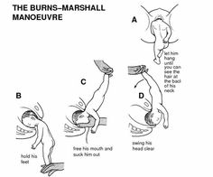 instructions for how to use the burns - marshall manoeuvre step by step