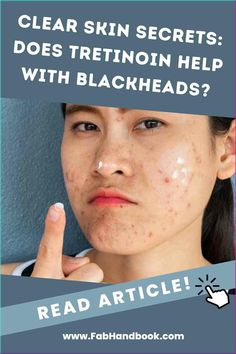 Clear Skin Secrets: Does Tretinoin Help with Blackheads? #Blackheadextraction  #Blackheadpoppingpimples  #Blackdotsinnose #Blackheadpopping #Skintreatmentsforacne Black Dots On Nose, Mini Twists Styles, Tretinoin Acne, What Causes Pimples, Blackhead Extraction, Spring Skin, Exotic Hairstyles, Nose Makeup