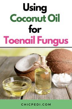 Natural Nail Fungus Remedy, Natural Remedies For Toenail Fungus, Nail Fungal Infection Toenails, Toe Fungus Remedy, Nail Fungus Remedies, Foot Fungus Remedies