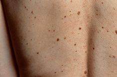 the back of a person with freckles on their skin