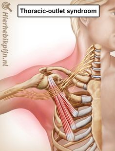 Thoracic-outlet syndroom | Hier Heb Ik Pijn Body Muscle Anatomy, Human Body Organs, Chronic Pain Relief, Acupressure Massage