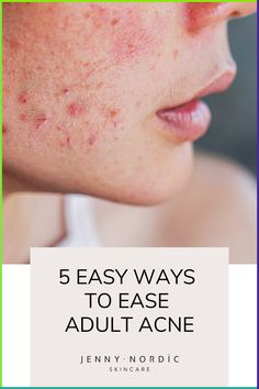 Learn 5 easy steps to ease adult acne. #holisticskincare #perimenopause #adultacne Weekly Skincare Routine, Weekly Skincare, Cystic Acne Remedies, Spring Skin, Skincare Masks, Holistic Skin Care, Remedies For Skin, Holy Grail Products, Fashion On A Budget