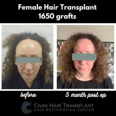 Hair Transplant Photos | Civas Hair Transplant Female Hair Transplant