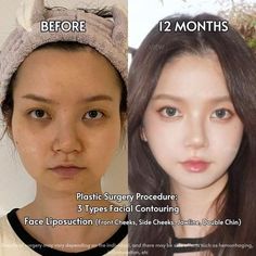 Kpop Plastic Surgery, Jaw Reduction Surgery, Change Appearance, Plastic Surgery Korea, Korean Plastic Surgery, Plastic Surgery Photos