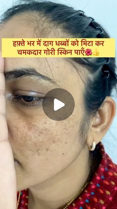 Pigmentation Remedy, Skin Care Pictures, Natural Skin Care Ingredients, Face Skin Care Routine, Dark Spots On Face, Diy Skin Care Routine, Dark Spots On Skin, Beauty Tips For Glowing Skin, Perfect Skin Care Routine