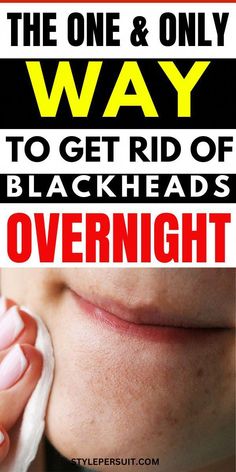 Blackheads On Face, Blackhead Remover Diy, Blackhead Mask, Face Care Routine, Types Of Acne, Get Rid Of Blackheads