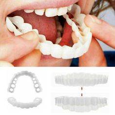 Snap On Smile, Teeth Covers, Temporary Tooth, Veneers Teeth, False Teeth, Fake Teeth, Loose Tooth, Teeth Braces, Yellow Teeth