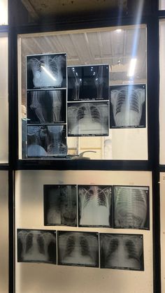 an x - ray image is displayed on the wall in front of some other images