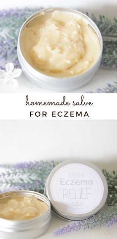 Anti Itch Salve Diy, Coconut Oil For Excema, Homemade Excema Cream, Homemade Excema Remedy, Diy Excema Relief, What Helps Excema, Soap For Excema Sensitive Skin, Natural Remedy For Excema, How To Treat Excema