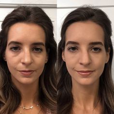 Remove Under Eye Bags, Botox Under Eyes, Jaw Reduction Surgery, Plastic Surgery Fail, Botox Before And After, Face Surgery, Plastic Surgery Gone Wrong