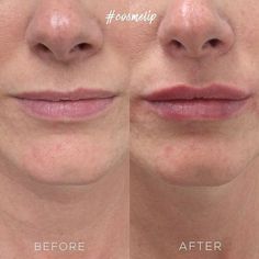 Lip Fillers Before And After 1ml, 0.5 Ml Lip Filler Before And After, Natural Lip Fillers, Lip Inspiration, Lip Job, Hyaluronic Acid Lips, Lip Types