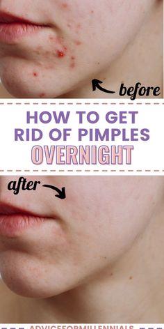 Overnight Pimple Remedies, Pimple Remedies, Zit Remedy, Huge Pimple, Dry Out Pimples