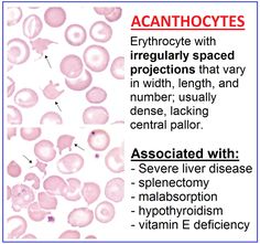 an image of acanthocytes with irregularly spaced projections that vary in width, length, and number