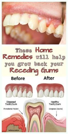 Heal Cavities, Swollen Gum, Poor Nutrition, Gum Health, Oral Health Care