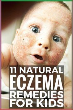 11 Natural Eczema Remedies for Kids. If one or more of your children suffers from dry, red, raw, weeping, itchy skin, these natural treatments will not only teach you how to get rid of your child’s eczema, but will also help you prevent future flares. From homemade ideas to oils and lotions to spotting and treating food allergies, these natural remedies and eczema products have been a lifesaver to me and my son! #eczema #psoriasis #itchy #skin #dermatitis #remedies #naturalremedies Allergy Remedies For Kids, Eye Stye Remedies, Me And My Son, Natural Remedies For Allergies, Snoring Remedies, Homemade Ideas, Allergy Remedies, Kids Homemade, Skin Remedies