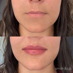 Subtle Lip Filler Before And After, Subtle Lip Filler, Armonizacion Facial, Lip Filler Technique, Filler Inspiration, Lip Lift, Danielle Smith