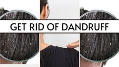 How To Treat Dandruff, Halloween Nail Art Tutorial, Dandruff Flakes