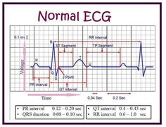 Normal Ecg, Nursing Labs, Medical Assistant Student, Nclex Study, Medicine Notes