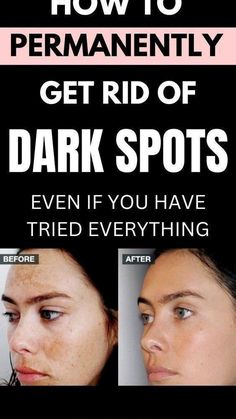 Oil For Dark Spots, Diy Facial Moisturizer, Dark Spots Remedies, Dark Spots On Face, Diy Anti Aging, Spots On Face, Skin Specialist, Remove Dark Spots, Skin Care Solutions