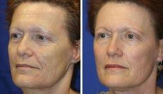 Facial Training, Facelift Exercises, Facial Acupressure, Tightening Workout, Gymnastics Exercises, Face Massaging, Facelift Without Surgery, Facial Fitness, Natural Facelift