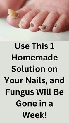 Natural Toenail Fungus Remedy, Foot Care Tips, Toenail Fungus Remedies