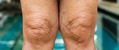 7 Ways to Get Rid of Crepey Skin on Legs - Innovations Medical Skin Tightening Procedures, Skin Tightening Treatments, Fractional Laser, Skin Growths, Basic Skin Care Routine